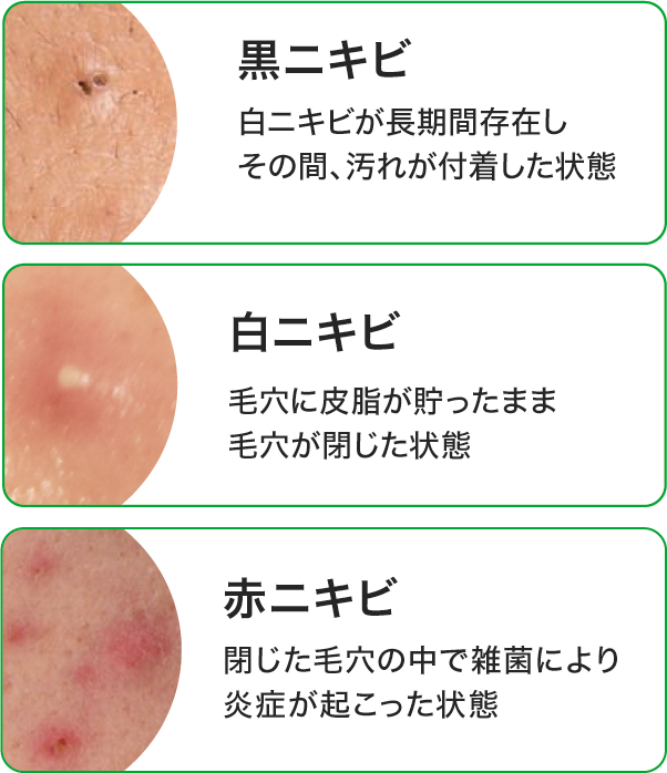 ニキビ ニキビ